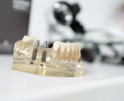 Präzise gesetzte Implantate bilden die Basis für Implantatgetragenem Zahnersatz
